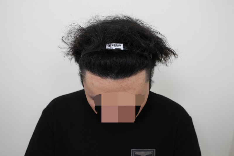 신사역 모프로의원 절개모발이식 1년 2개월차 후기