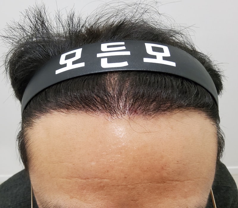 5. 수술후_1년_1.jpg