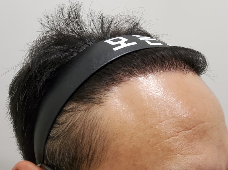 5. 수술후_1년_3.jpg