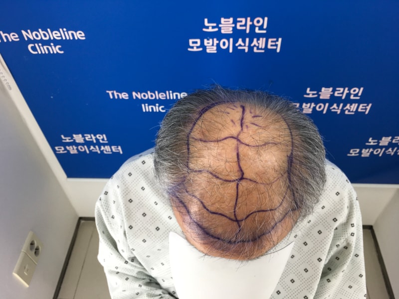대량이식 100일 조금 넘어가는데 매일이 신기합니다.