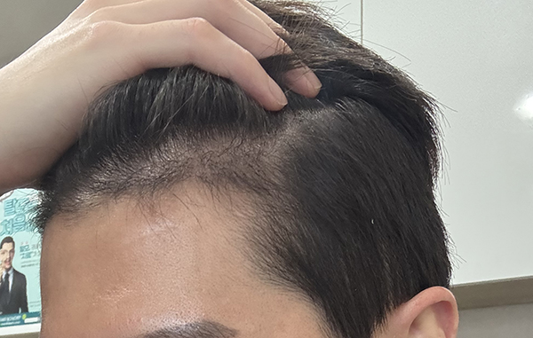 6-왼쪽은 암흑기 때 조금더 많이 빠졌어요.jpg