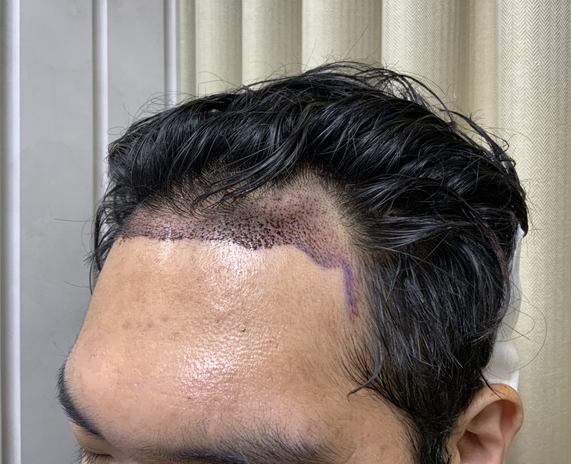 수술후1일차2.png