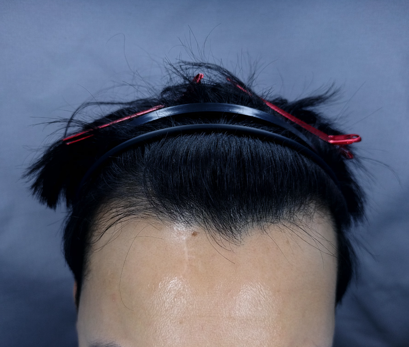 Men's m-shaped 2,000 wool + 500 wool = 2,500 wool Hair Transplant