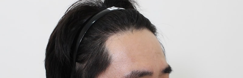 시술후3.JPG
