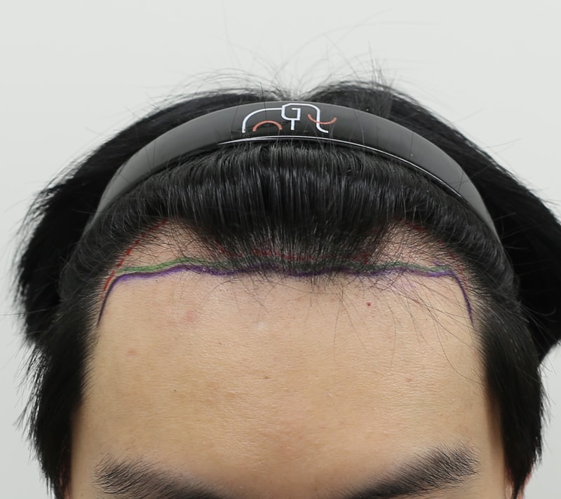 Apgujeong Mammoth Hair Restoration Center 4th month review.