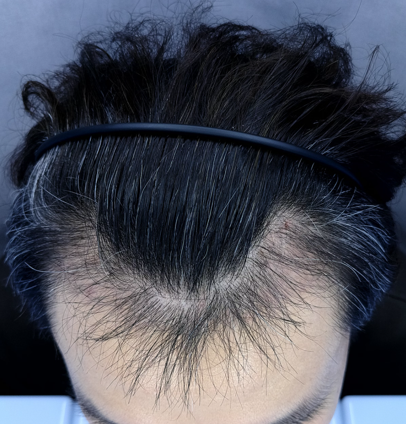 조정배86 3000모 이식 후 3mo.png