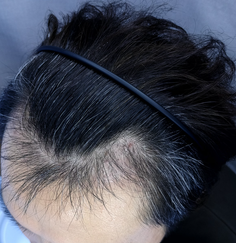 조정배86 3000모 이식 후 측면 3mo.png
