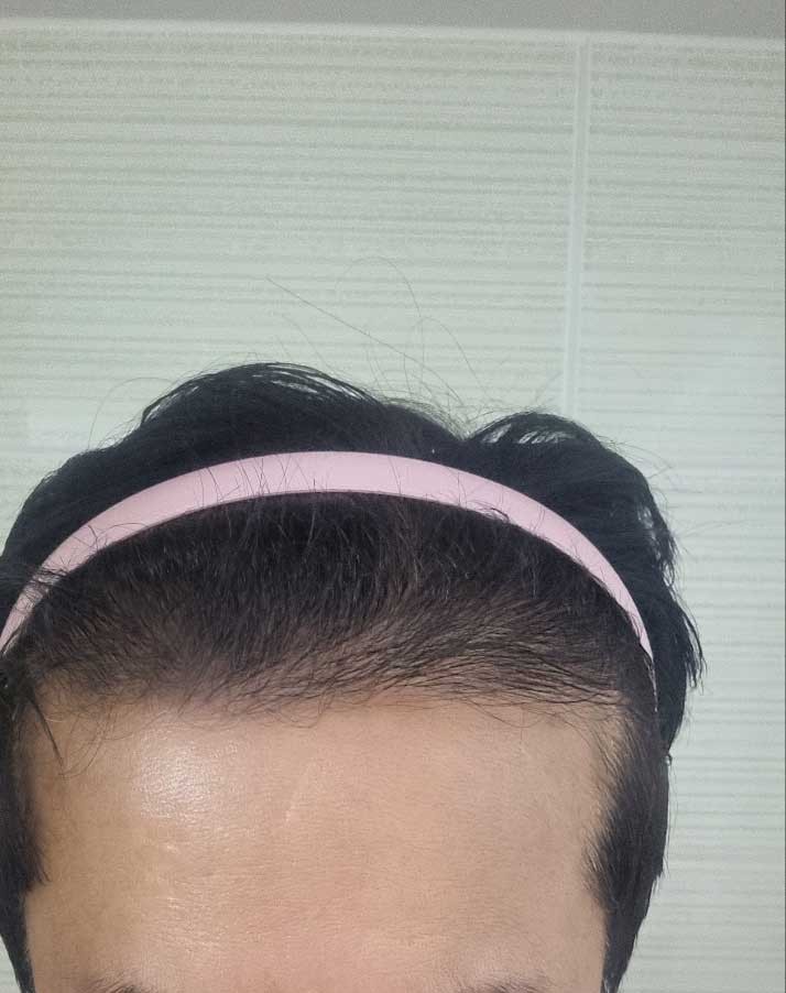 다나성형외과 비절개 대량이식 5개월 경과 암흑기 종료