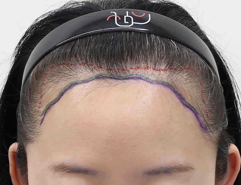 Incheon Mammoth Hairline Non-Cutting Hair Transplant 1137 Hair follicle Surgery Review