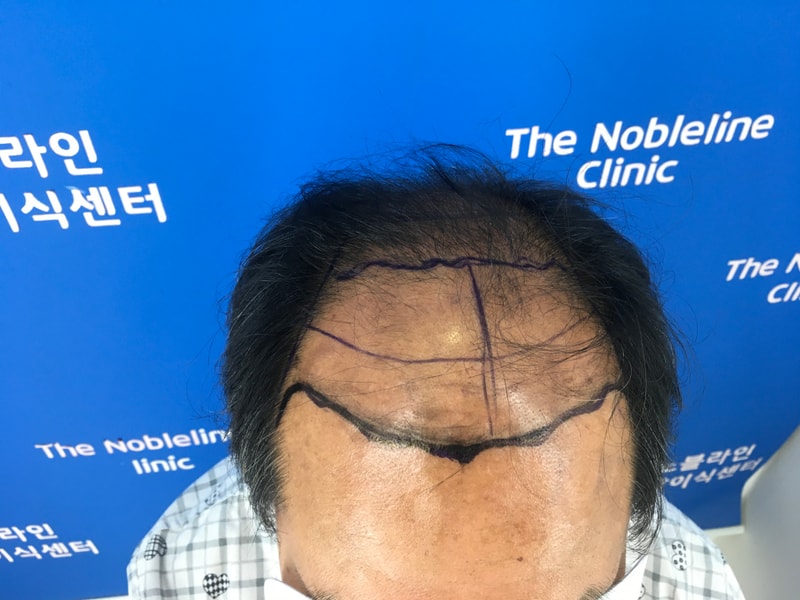 8000모 이상 대량이식 139일차 입니다.