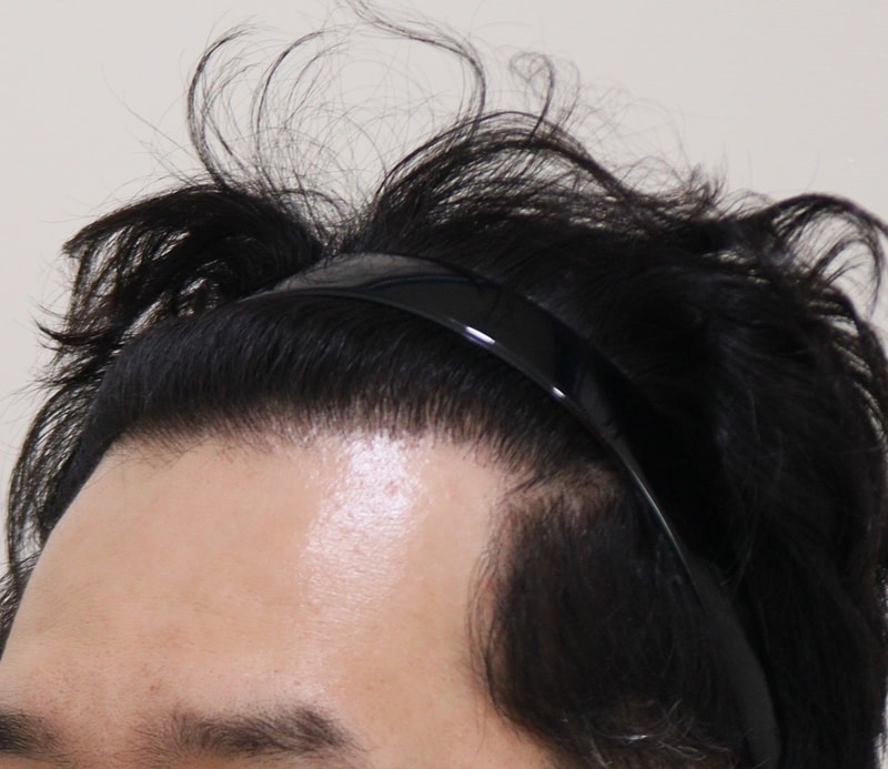 4. 수술후_1년_2.JPG