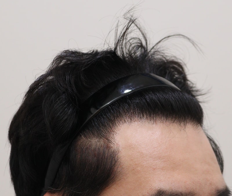 4. 수술후_1년_3.JPG