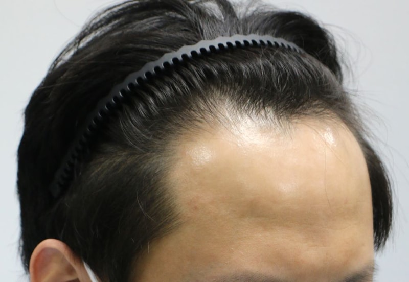 5.수술전.JPG