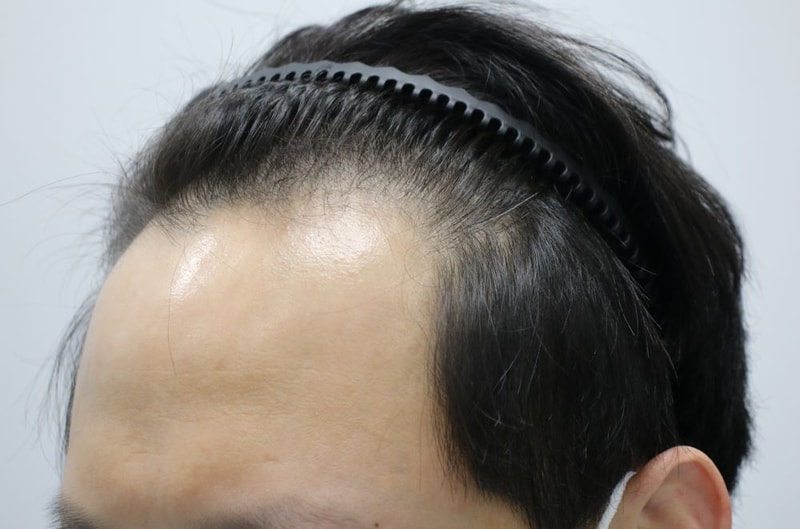 6.수술전.JPG