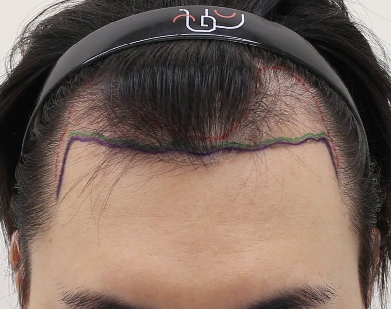 Incheon Mammoth Hair Restoration Center Hairline Non-Cutting Slit Hair Transplant 1399 On the Day of Hair follicle Surgery