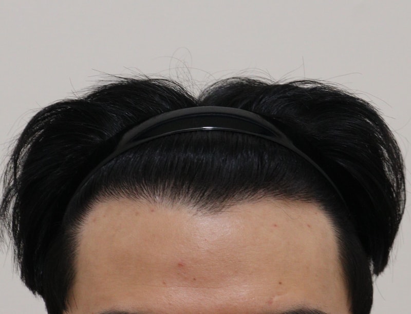 4. 수술후_1년_1.JPG