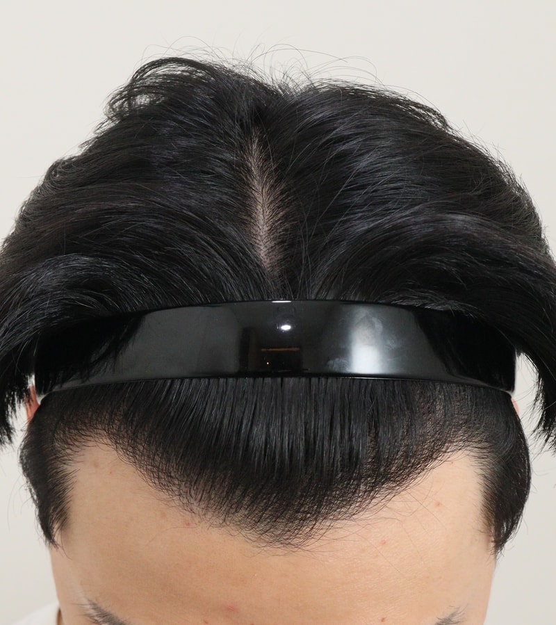 4. 수술후_1년_2.JPG