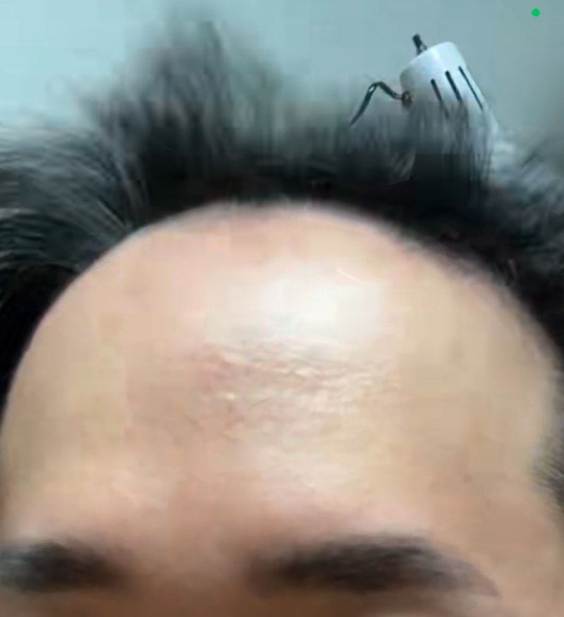 Finally, it's been a year! Hairline 1700 Hair Ornament No-Cutting Non-Cutting Hair Transplant MO.1 plastic surgery