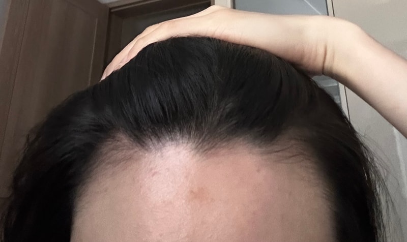 Dongtan Hairrow House Hair Transplant 2800 Mo 2nd Week Review