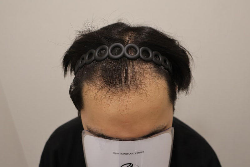 9 months review of bangs Hair Transplant.