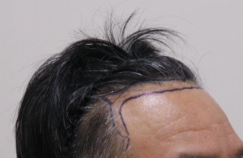 1. 수술전_3.JPG