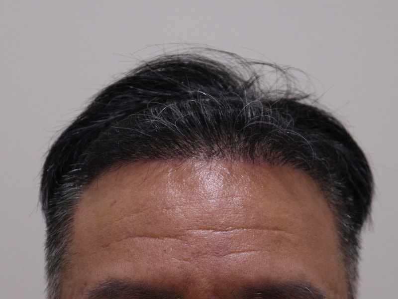 3. 수술후_6개월_1.JPG