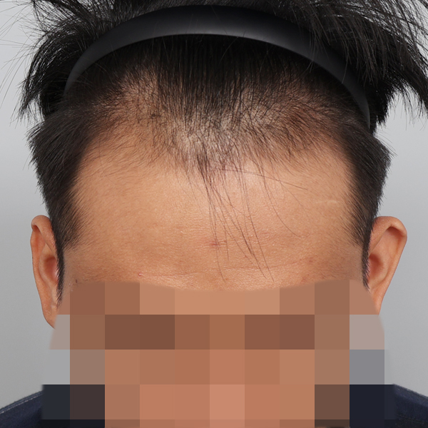 [Seojin Plastic Surgery] I got my age back with an M-shape Hair Transplant.