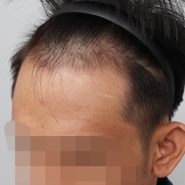 수술 전 (1).jpg