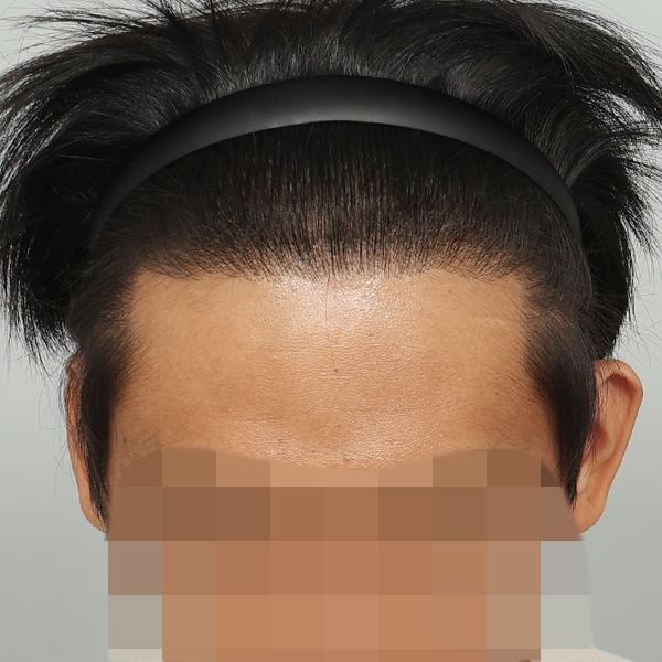 수술 후 391일차 (2).jpg