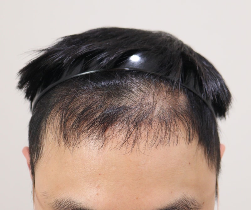 3. 수술후_6개월_2.JPG