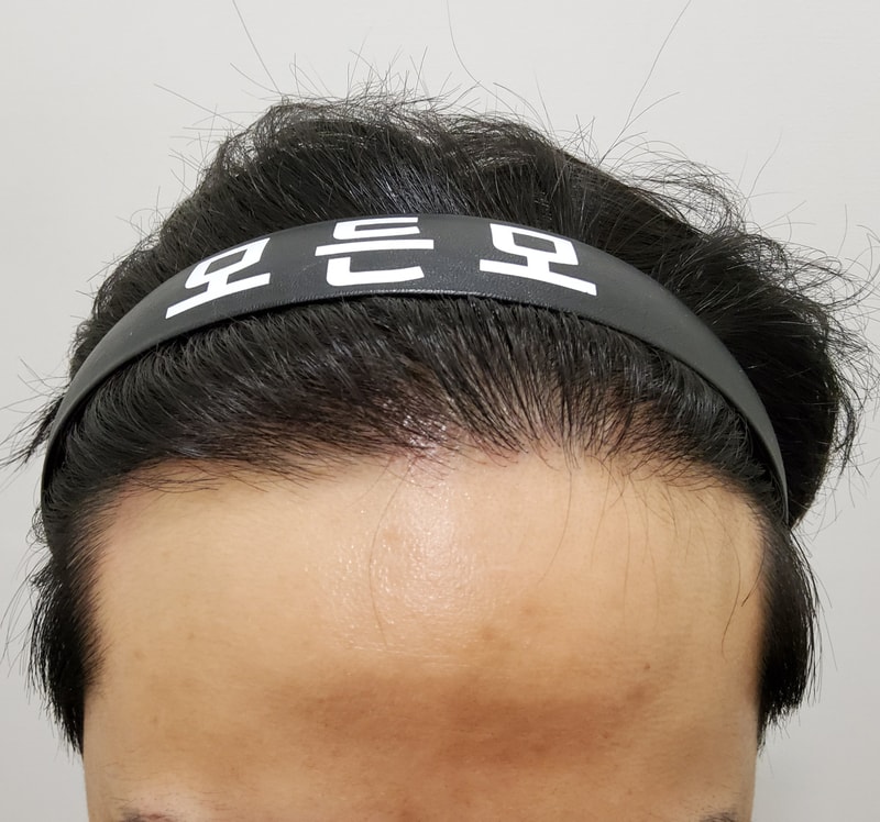 4. 수술후_1년_1.jpg