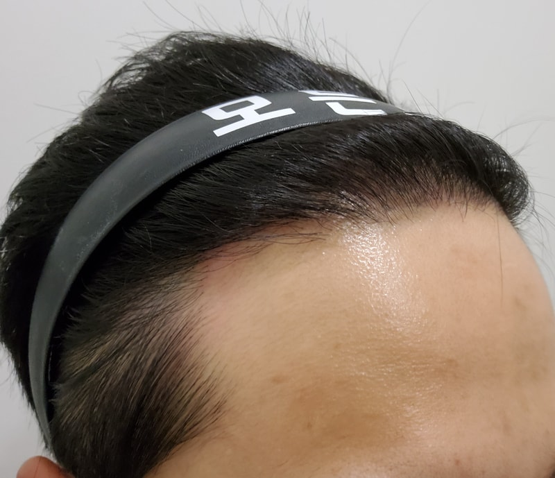 4. 수술후_1년_3.jpg