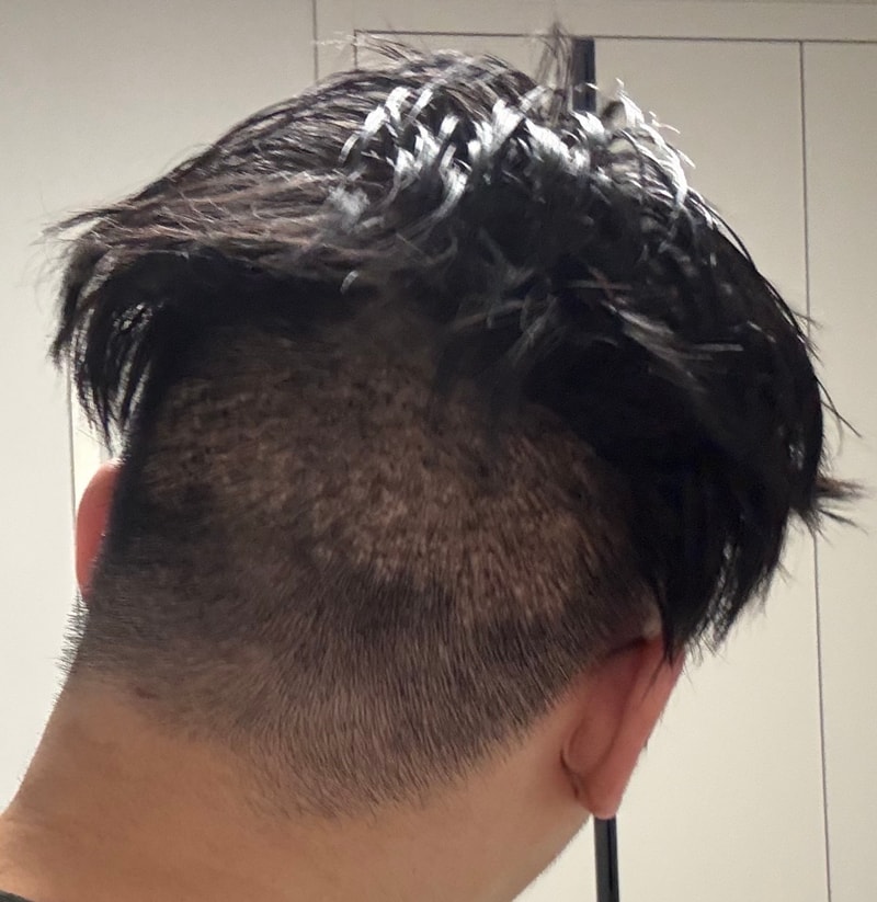 [Michelan Clinic] Review of Body Hair Transplant in Mikhelan, occipital scar after surgery failure at another hospital