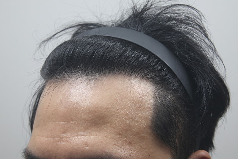 모나라피부과_모발이식_12개월경과-(2).jpg