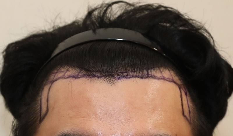 뉴헤어 비절개모발이식 3000모 비절개 9개월 후기입니다.
