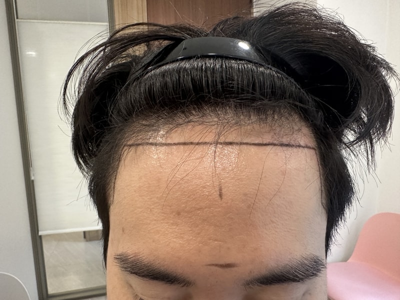 MOEM Clinic Hidden Cut 3230mo review!