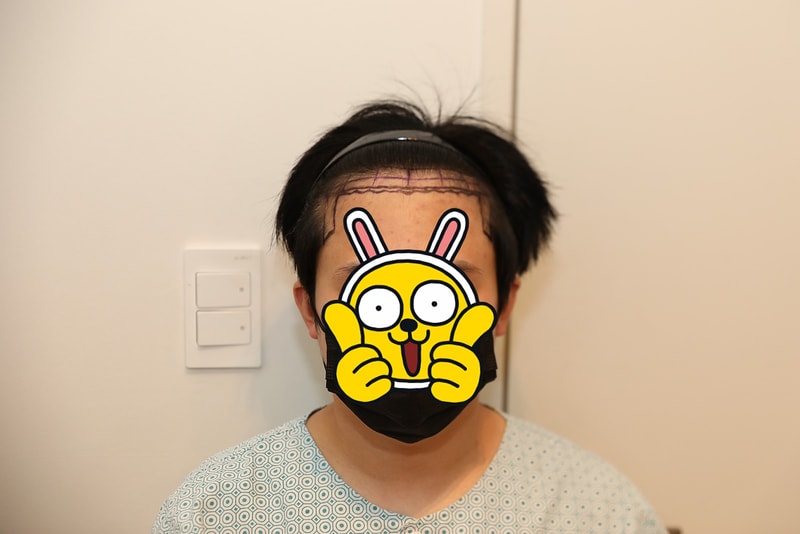 뉴헤어 비절개 1700모낭(3400모) 모발이식 후기입니다