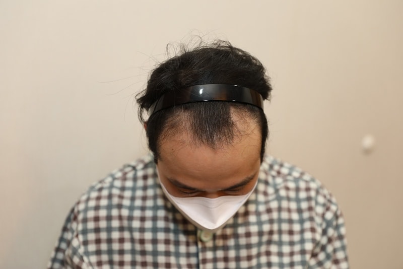 뉴헤어 절개 모발이식 9개월 후기