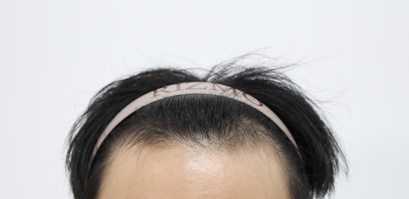 수술경과 17일째 입니다^_