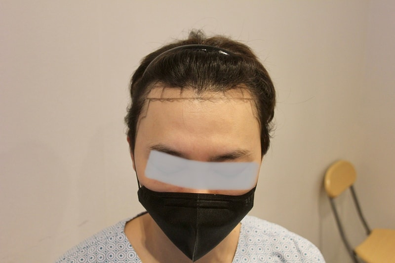 뉴헤어 비절개 1745모낭 10일차 후기