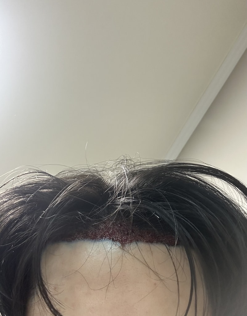 모엠의원 전지훈 원장님 1900모 수술 후기