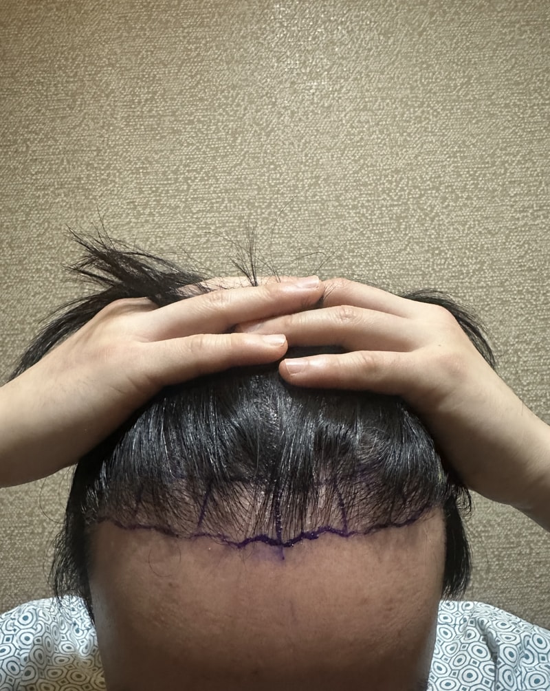 ニューヘアー2日目 雨切り植毛 体験談/1500株