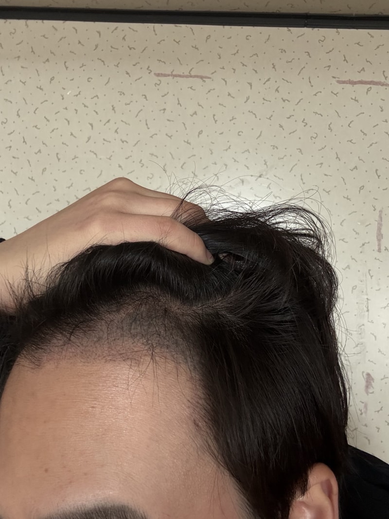 This is the review of 4,000 non-cut Hair Transplant in the 3rd month of NEWHAiR.