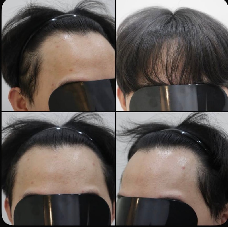 광주 압구정모비앙의원 모발이식 10개월 경과후기