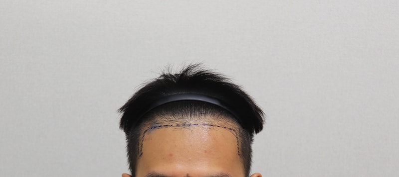 1.수술전 디자인 IMG_5182.JPG