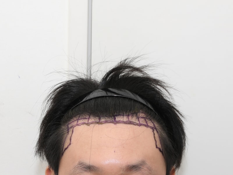뉴헤어 서울점 모발이식 후기