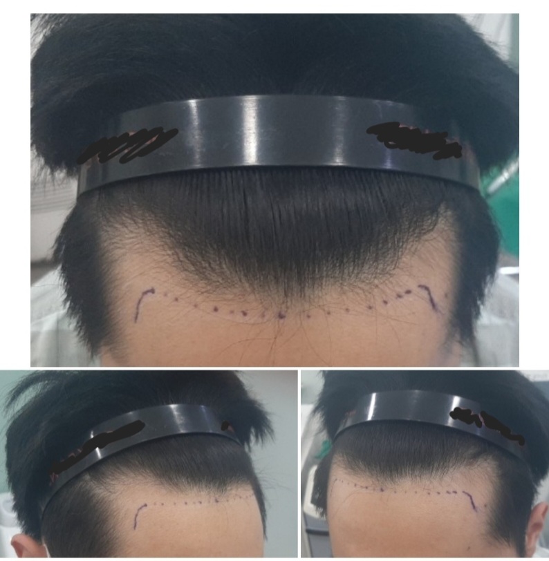 It's a 5 and a half month review of hair transplantation.