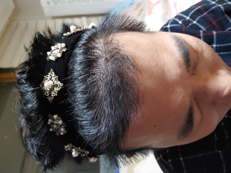 Late review of 6 months finally after a 3000m Modi hair implant transplant.
