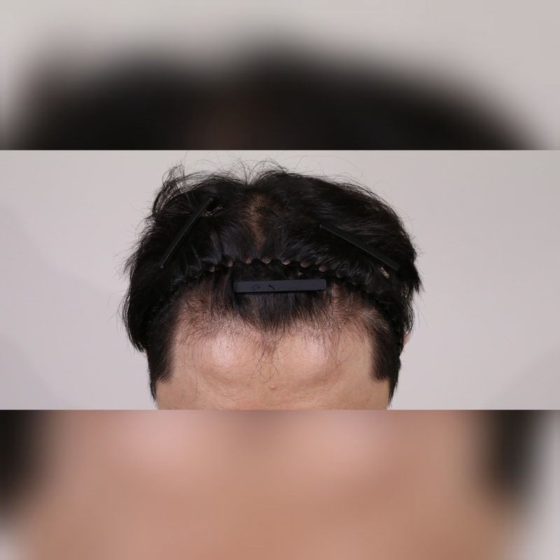 [[압구정 모우림]] 앞머리 모발이식 후기입니다