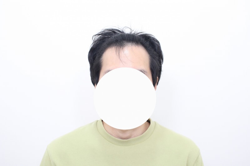 모프로의원 헤어라인 모발이식 비절개 3400모 6개월 경과
